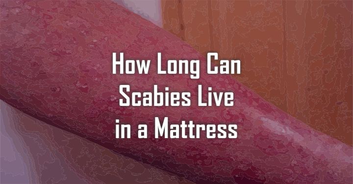 can scabies live in mattress